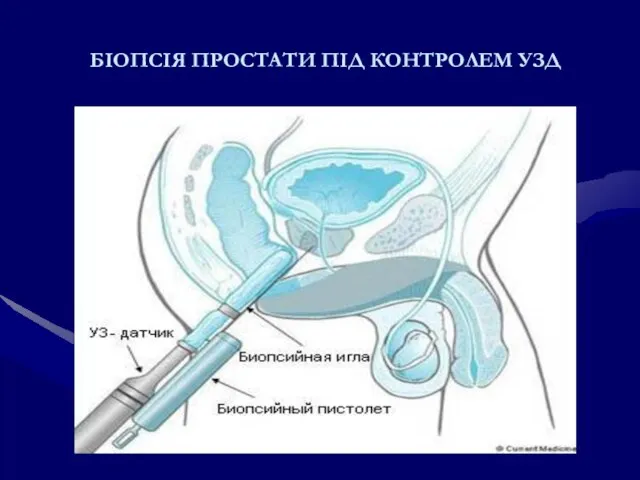 БІОПСІЯ ПРОСТАТИ ПІД КОНТРОЛЕМ УЗД