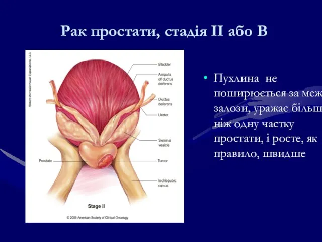 Рак простати, стадія IІ або В Пухлина не поширюється за межі залози,