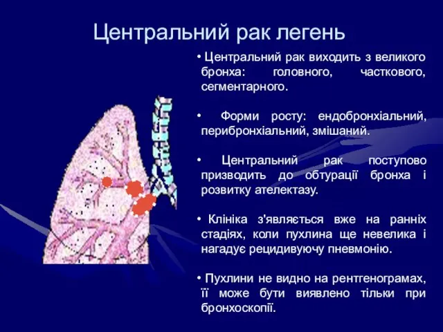 Центральний рак легень Центральний рак виходить з великого бронха: головного, часткового, сегментарного.