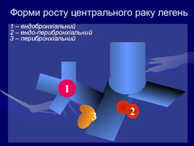 Форми росту центрального раку легень 1 – ендобронхіальний 2 – ендо-перибронхіальний 3