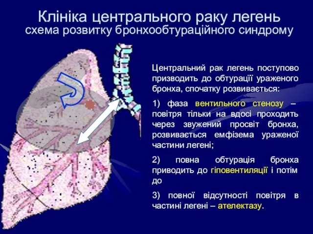 Клініка центрального раку легень схема розвитку бронхообтураційного синдрому Центральний рак легень поступово