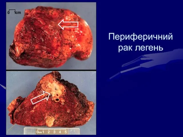 Периферичний рак легень