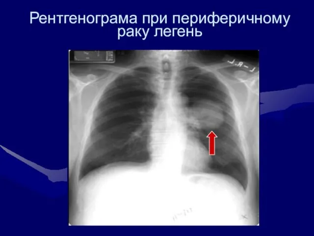 Рентгенограма при периферичному раку легень