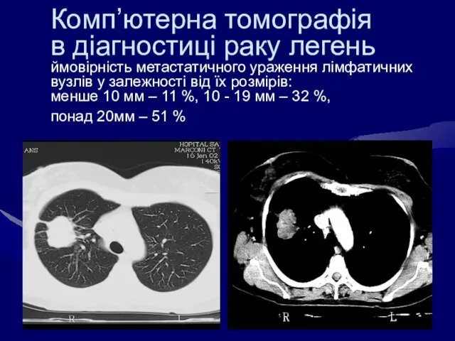 Комп’ютерна томографія в діагностиці раку легень ймовірність метастатичного ураження лімфатичних вузлів у