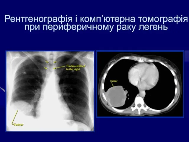 Рентгенографія і комп’ютерна томографія при периферичному раку легень