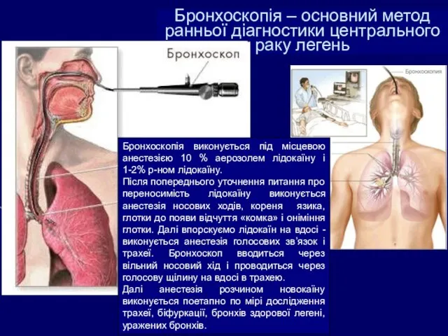 Бронхоскопія – основний метод ранньої діагностики центрального раку легень Бронхоскопія виконується під