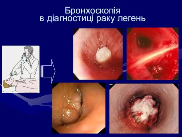 Бронхоскопія в діагностиці раку легень