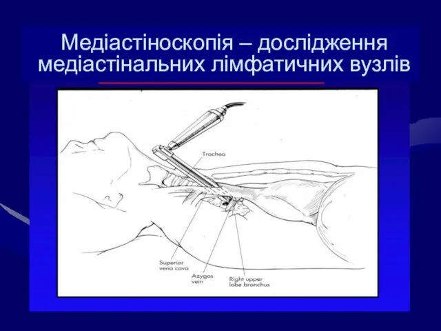 Медіастіноскопія – дослідження медіастінальних лімфатичних вузлів