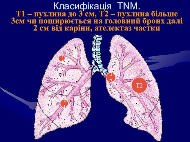 Класифікація TNM. Т1 – пухлина до 3 см, Т2 – пухлина більше