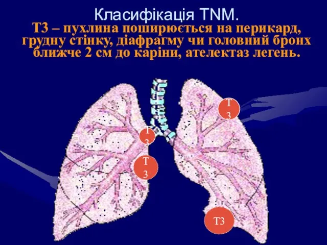 Класифікація ТNM. Т3 – пухлина поширюється на перикард, грудну стінку, діафрагму чи