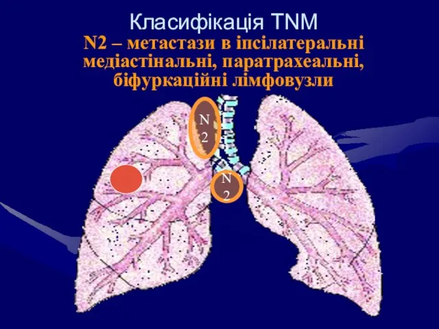 Класифікація ТNM N2 – метастази в іпсілатеральні медіастінальні, паратрахеальні, біфуркаційні лімфовузли N2 N2