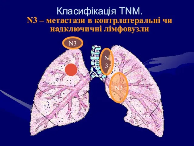 Класифікація ТNM. N3 – метастази в контрлатеральні чи надключичні лімфовузли N3 N3 N3