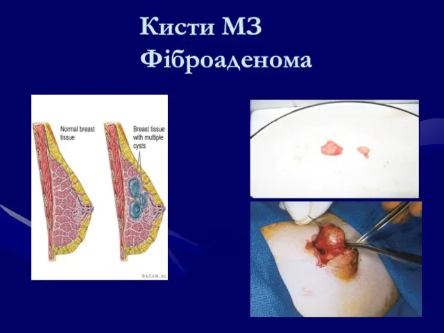 Кисти МЗ Фіброаденома