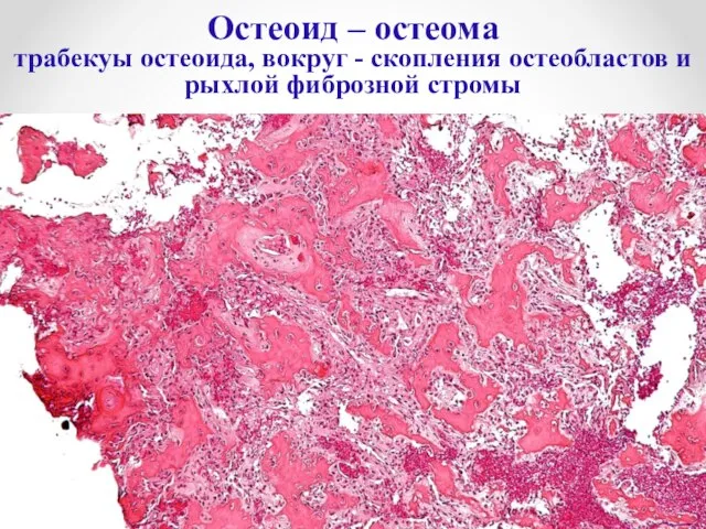 Остеоид – остеома трабекуы остеоида, вокруг - скопления остеобластов и рыхлой фиброзной стромы