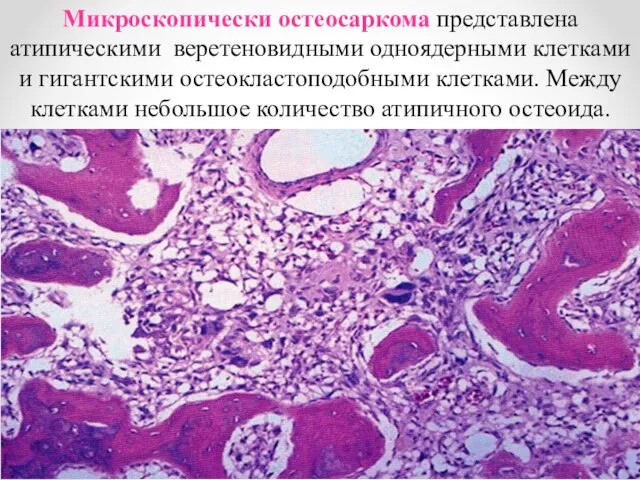 Микроскопически остеосаркома представлена атипическими веретеновидными одноядерными клетками и гигантскими остеокластоподобными клетками. Между