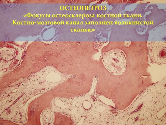 ОСТЕОПЕТРОЗ «Фокусы остеосклероза костной ткани. Костно-мозговой канал заполнен волокнистой тканью»