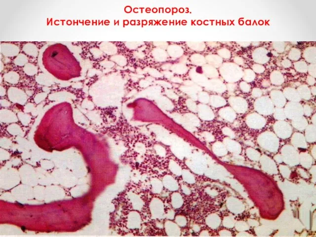 Остеопороз. Истончение и разряжение костных балок
