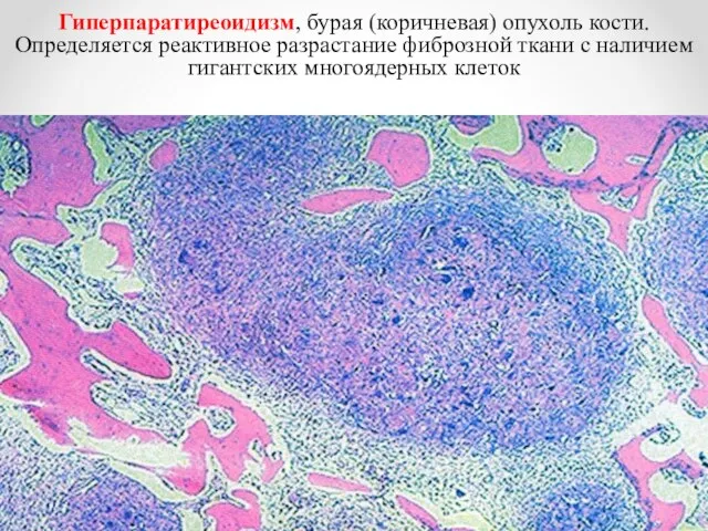 Гиперпаратиреоидизм, бурая (коричневая) опухоль кости. Определяется реактивное разрастание фиброзной ткани с наличием гигантских многоядерных клеток