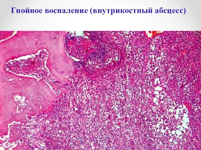 Гнойное воспаление (внутрикостный абсцесс)