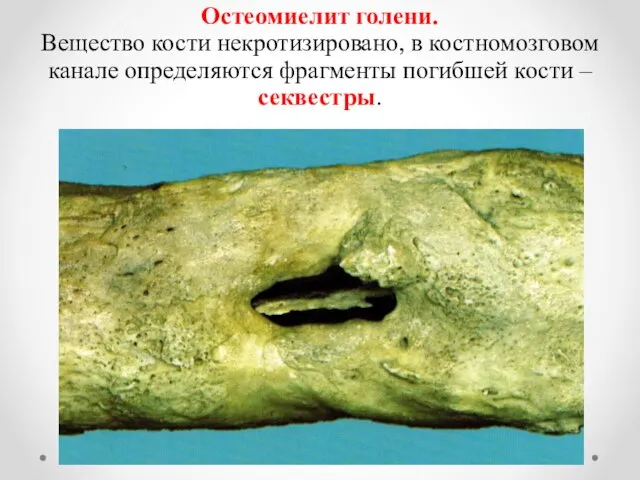 Остеомиелит голени. Вещество кости некротизировано, в костномозговом канале определяются фрагменты погибшей кости – секвестры.