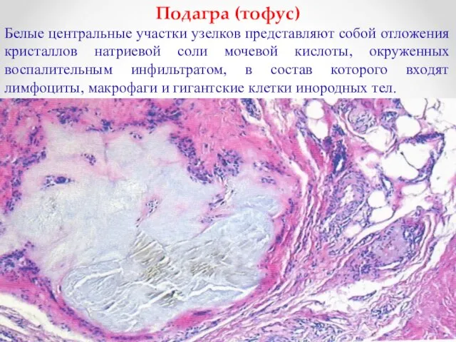 Подагра (тофус) Белые центральные участки узелков представляют собой отложения кристаллов натриевой соли