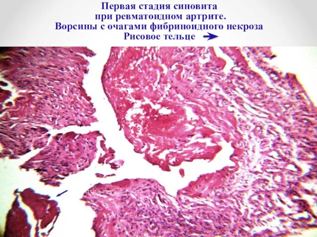 Первая стадия синовита при ревматоидном артрите. Ворсины с очагами фибриноидного некроза Рисовое тельце