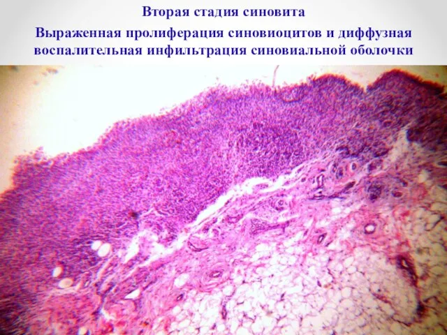 Вторая стадия синовита Выраженная пролиферация синовиоцитов и диффузная воспалительная инфильтрация синовиальной оболочки