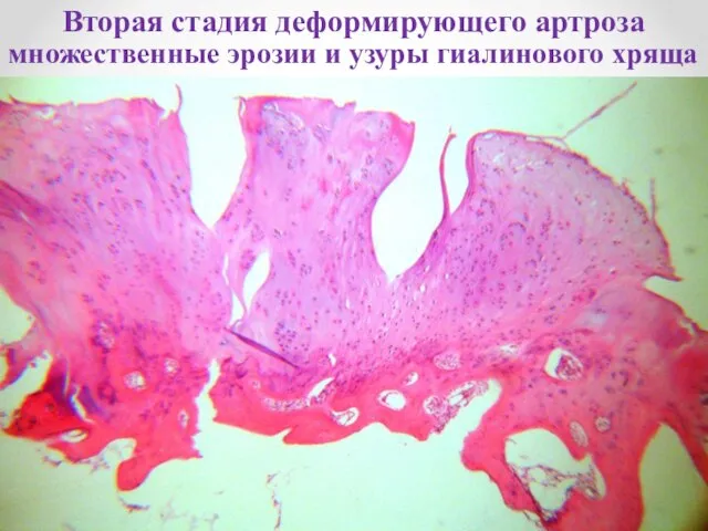 Вторая стадия деформирующего артроза множественные эрозии и узуры гиалинового хряща