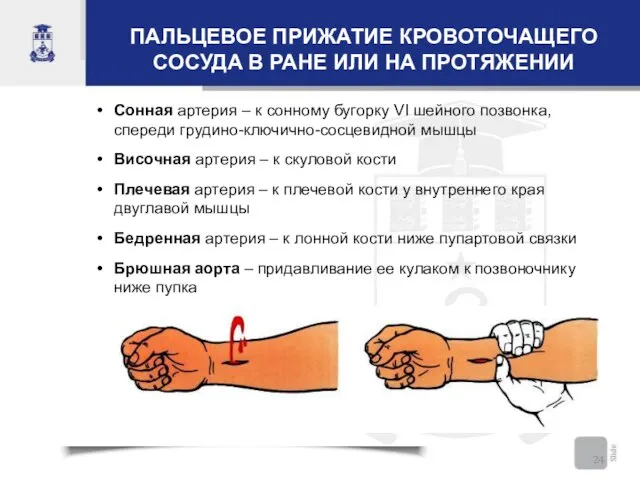 ПАЛЬЦЕВОЕ ПРИЖАТИЕ КРОВОТОЧАЩЕГО СОСУДА В РАНЕ ИЛИ НА ПРОТЯЖЕНИИ Сонная артерия –