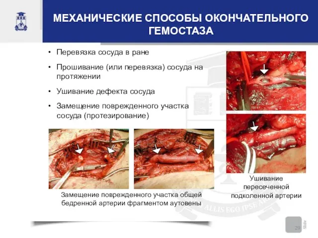 МЕХАНИЧЕСКИЕ СПОСОБЫ ОКОНЧАТЕЛЬНОГО ГЕМОСТАЗА Перевязка сосуда в ране Прошивание (или перевязка) сосуда