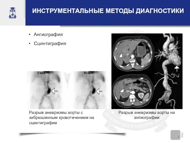 ИНСТРУМЕНТАЛЬНЫЕ МЕТОДЫ ДИАГНОСТИКИ Ангиография Сцинтиграфия Разрыв аневризмы аорты с забрюшинным кровотечением на