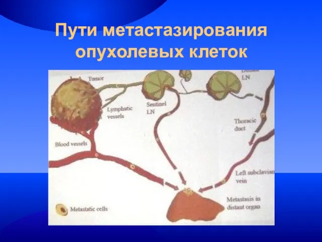 Пути метастазирования опухолевых клеток