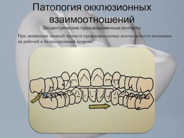 При движениях нижней челюсти преждевременные контакты могут возникать на рабочей и балансирующей