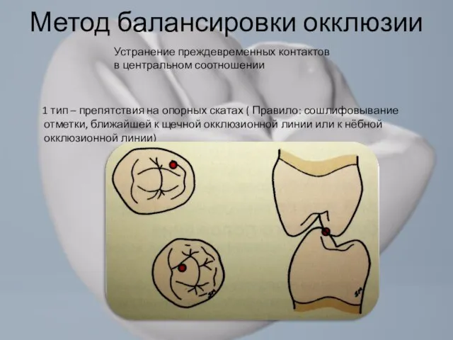 1 тип – препятствия на опорных скатах ( Правило: сошлифовывание отметки, ближайшей