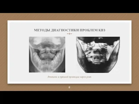 МЕТОДЫ ДИАГНОСТИКИ ПРОБЛЕМ КВЗ Рентген в прямой проекции через рот