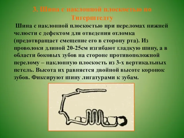 3. Шина с наклонной плоскостью по Тигерштедту Шина с наклонной плоскостью при