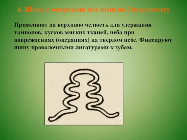 4. Шина с опорными петлями по Тигерштедту Применяют на верхнюю челюсть для