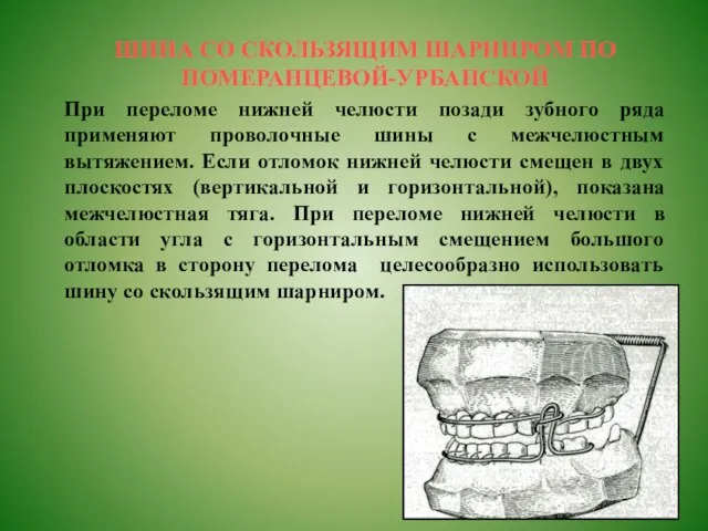 ШИНА СО СКОЛЬЗЯЩИМ ШАРНИРОМ ПО ПОМЕРАНЦЕВОЙ-УРБАНСКОЙ При переломе нижней челюсти позади зубного