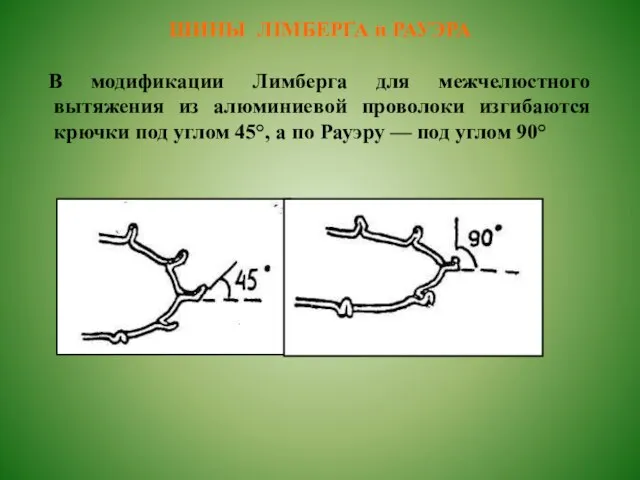 ШИНЫ ЛІМБЕРГА и РАУЭРА В модификации Лимберга для межчелюстного вытяжения из алюминиевой