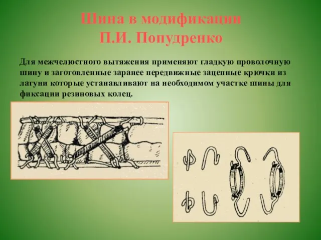 Шина в модификации П.И. Попудренко Для межчелюстного вытяжения применяют гладкую проволочную шину