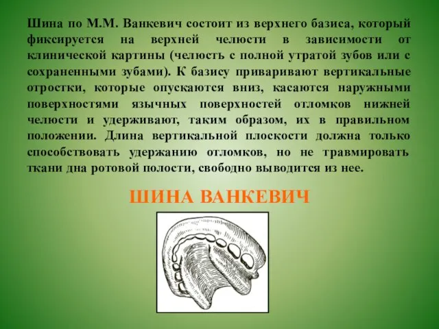 Шина по М.М. Ванкевич состоит из верхнего базиса, который фиксируется на верхней