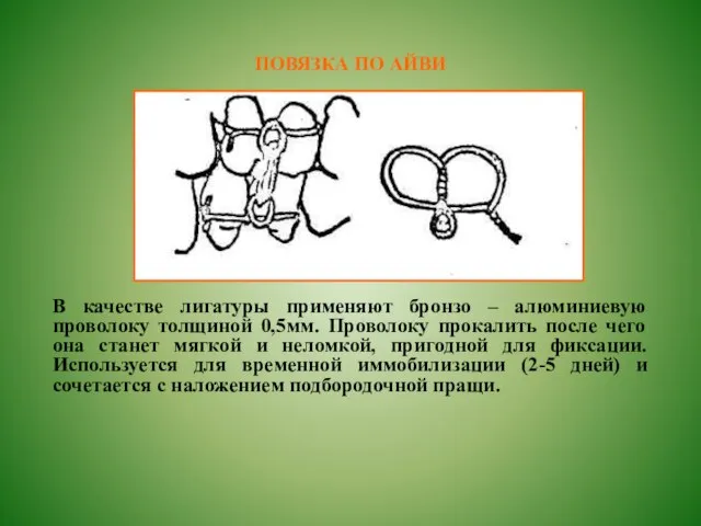 ПОВЯЗКА ПО АЙВИ В качестве лигатуры применяют бронзо – алюминиевую проволоку толщиной