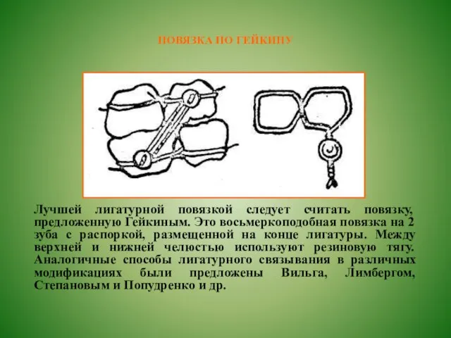 ПОВЯЗКА ПО ГЕЙКИНУ Лучшей лигатурной повязкой следует считать повязку, предложенную Гейкиным. Это