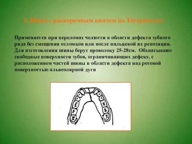 Шина с распорочным винтом по Тигерштедту Применяется при переломах челюсти в области