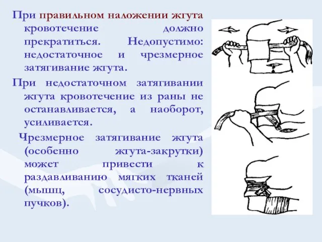 При правильном наложении жгута кровотечение должно прекратиться. Недопустимо: недостаточное и чрезмерное затягивание