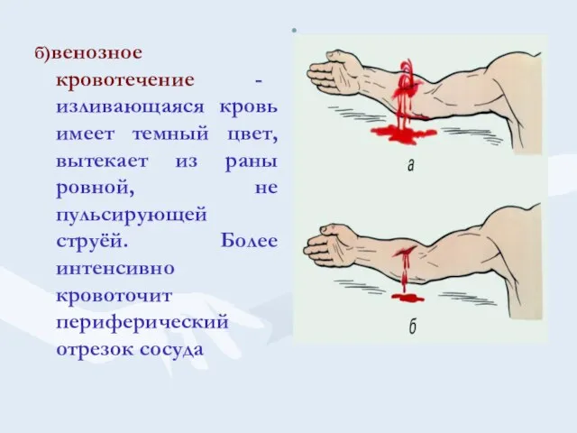 . б)венозное кровотечение - изливающаяся кровь имеет темный цвет, вытекает из раны