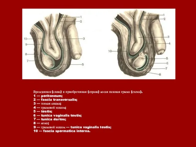Врожденная (слева) и приобретенная (справа) косая паховая грыжа (схема). 1 — peritoneum;