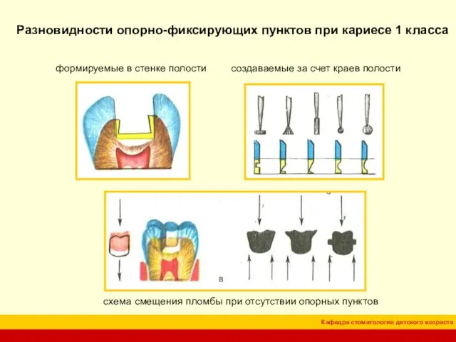 формируемые в стенке полости Разновидности опорно-фиксирующих пунктов при кариесе 1 класса создаваемые