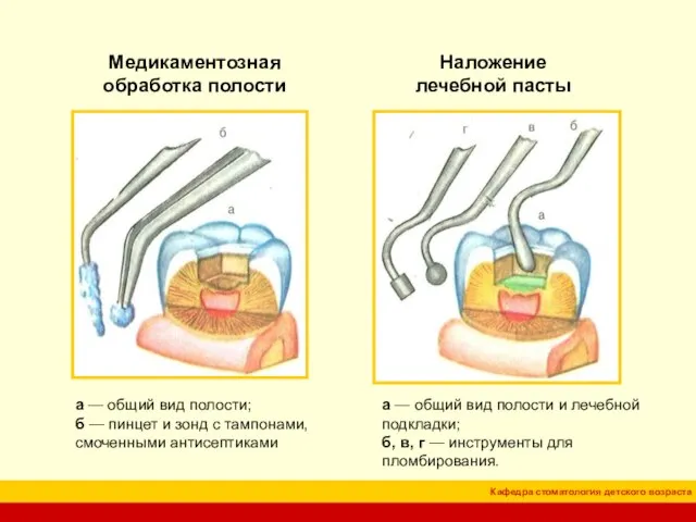 Медикаментозная обработка полости Наложение лечебной пасты а — общий вид полости; б