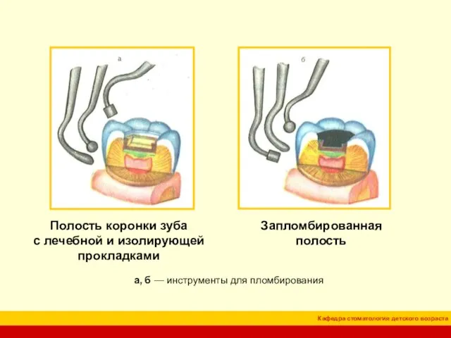 Полость коронки зуба с лечебной и изолирующей прокладками а, б — инструменты для пломбирования Запломбированная полость